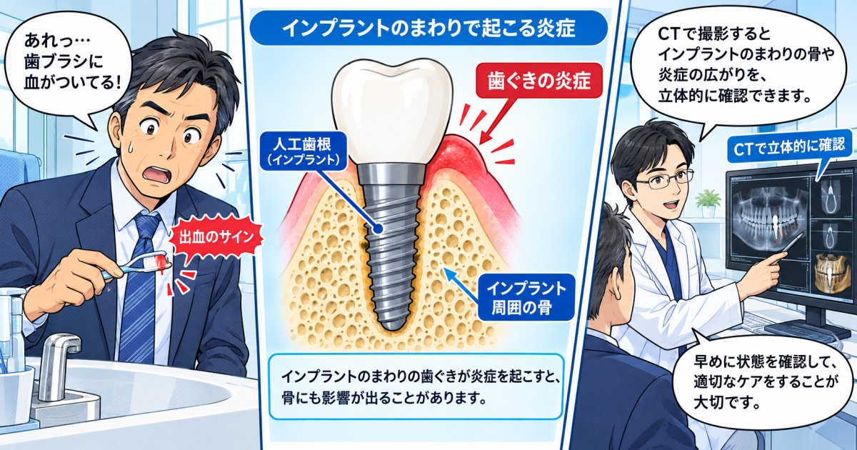 インプラントの出血は周囲炎の初期症状？骨吸収リスクと受診基準