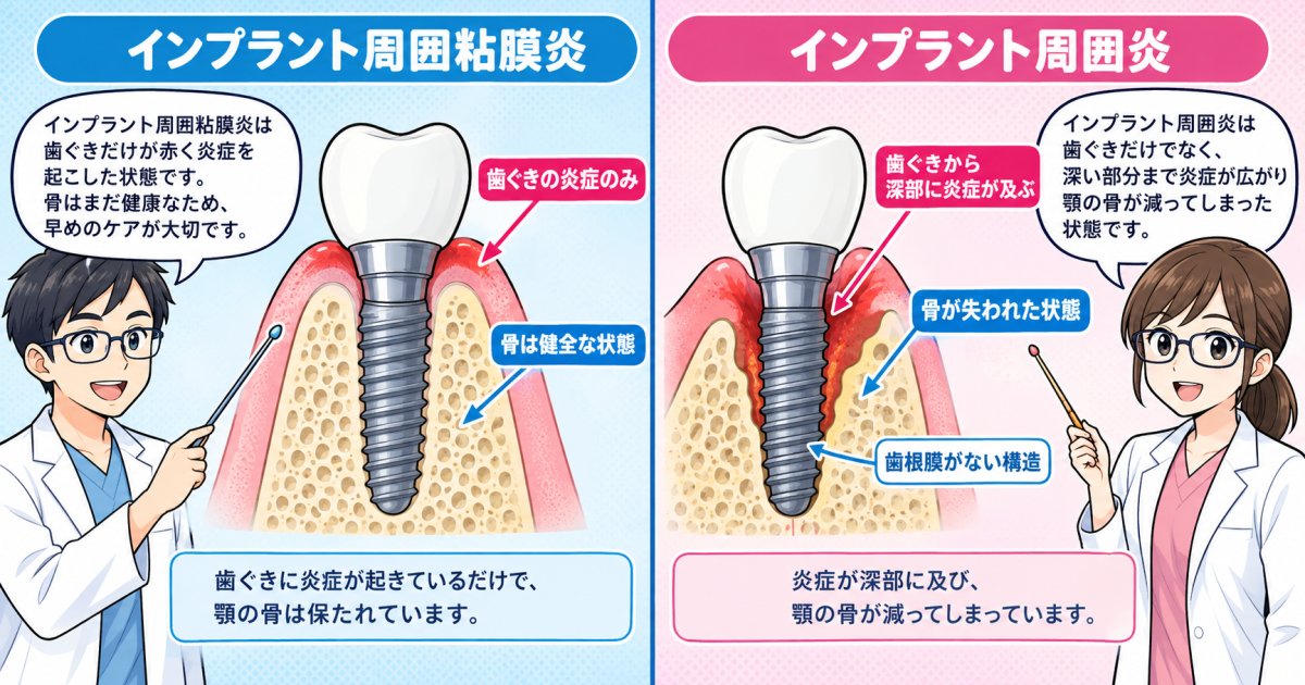 インプラント周囲炎の初期症状と粘膜炎の境界線