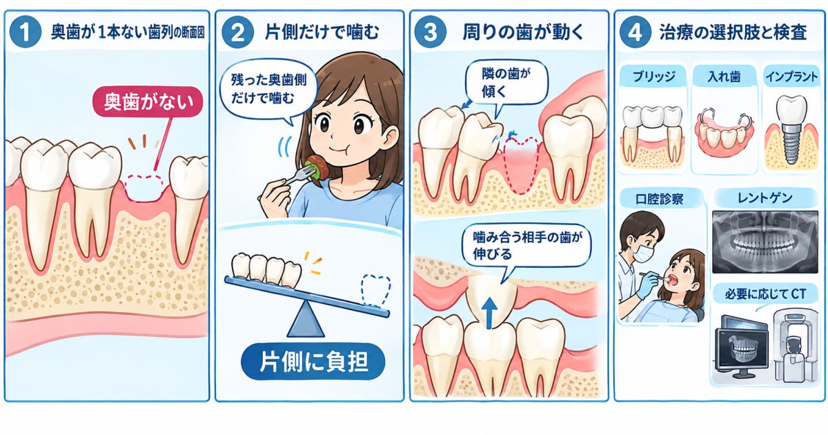 片方ばかりで噛んでいませんか？奥歯の欠損と噛み合わせの治療